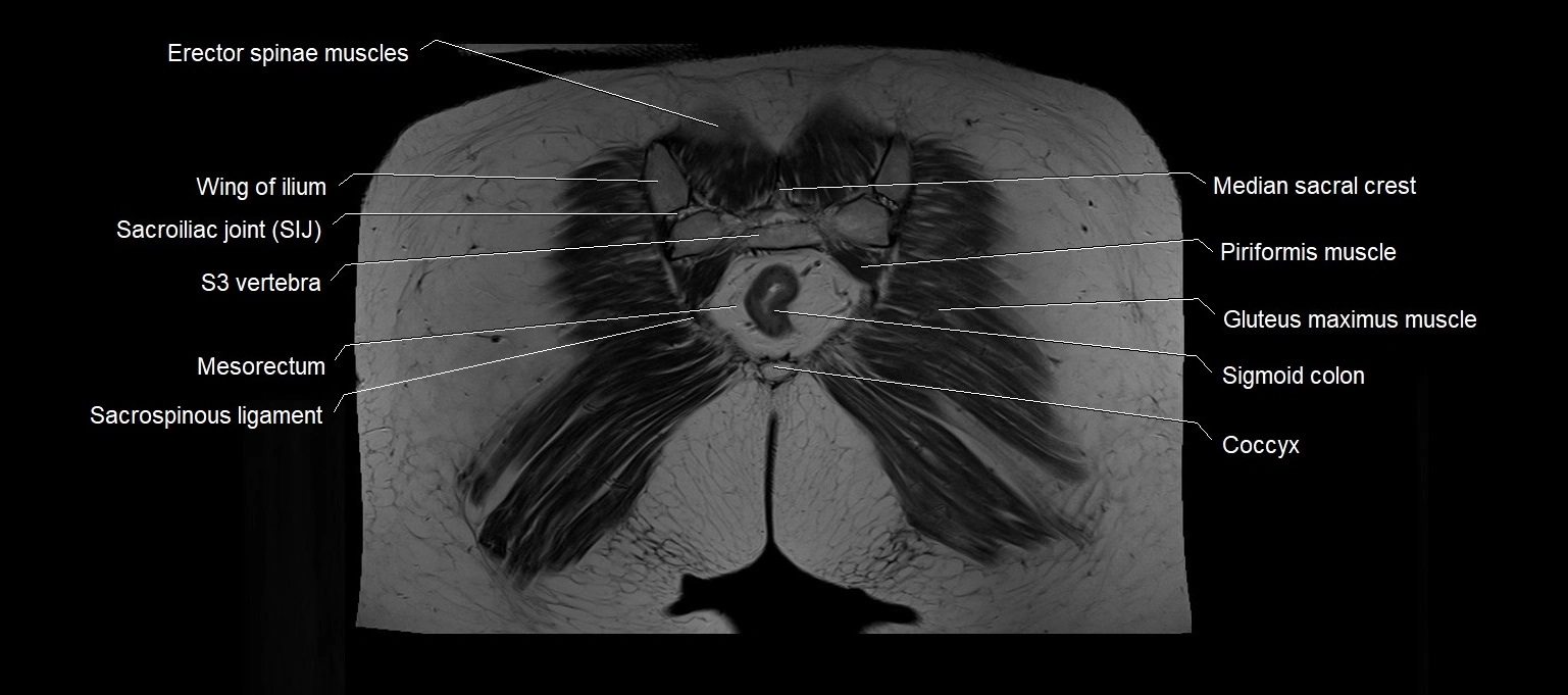 MRI 3T pelvis coronal cross section anatomy image 26.webp